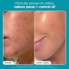 Clear, Smooth Skin with Paula’s Choice BHA Exfoliant
