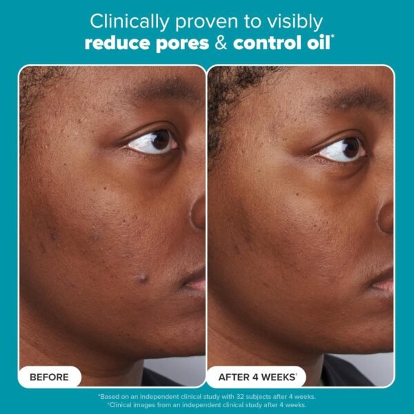 Clear, Smooth Skin with Paula’s Choice BHA Exfoliant